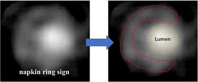 Novel imaging modalities for the identification of vulnerable plaques